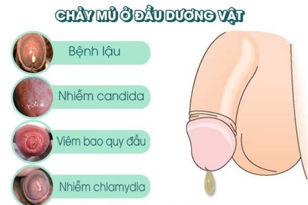 Chảy mủ ở nam giới cảnh báo nhiều bệnh lý khác nhau