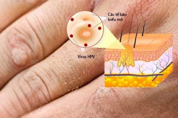 Mụn cơm là bệnh ngoài da do virus HPV gây nên
