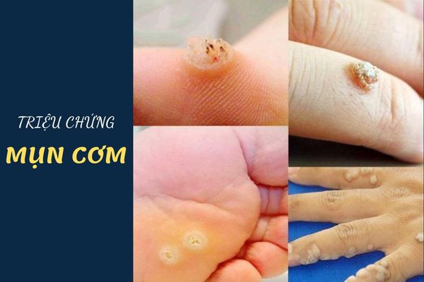 Triệu hứng nhận biết mụn cơm