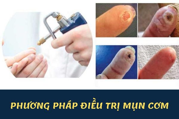 Phương pháp điều trị mụn cơm hiệu quả