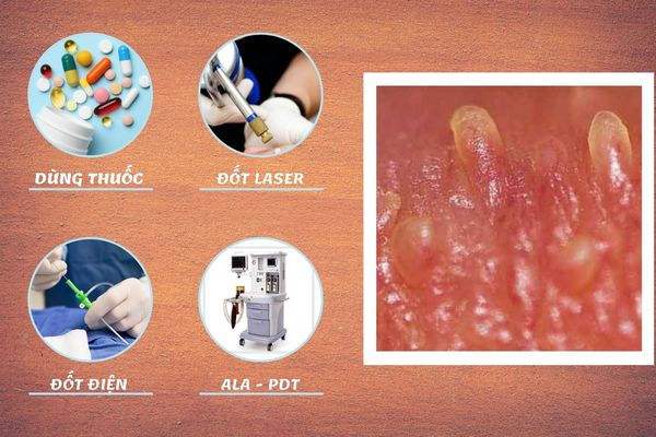 Phương pháp điều trị u nhú sinh dục hiệu quả
