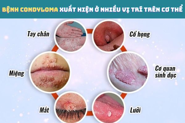 Bệnh Condyloma xuất hiện ở nhiều vị trí trên cơ thể
