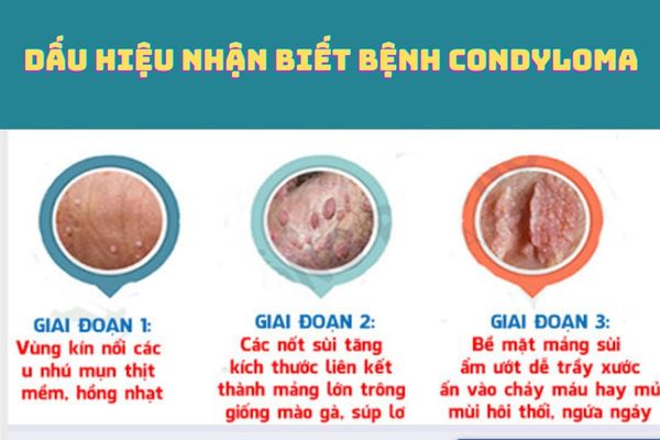 Các triệu chứng nhận biết bệnh Condyloma phổ biến