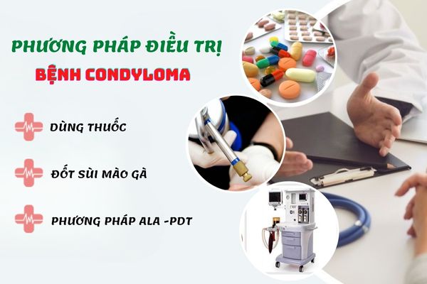 Phương pháp điều trị bệnh Condyloma hiệu quả