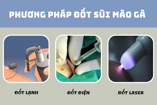 Phương pháp ddotsosuif mào gà loại bỏ virus HPV hiệu quả