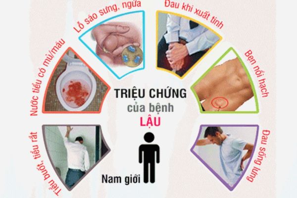 Triệu chứng bệnh lậu ở nam giới