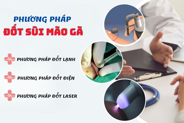 Một số phương pháp đốt sùi mào gà phổ biến hiện nay