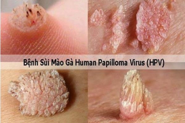 Dấu hiệu nhận biết bệnh sùi mào gà