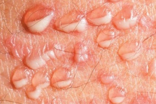 Nốt sần vùng kín là dấu hiệu của bệnh mụn rộp sinh dục