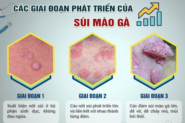 Quan hệ bằng miệng dễ lây nhiễm bệnh sùi mào gà