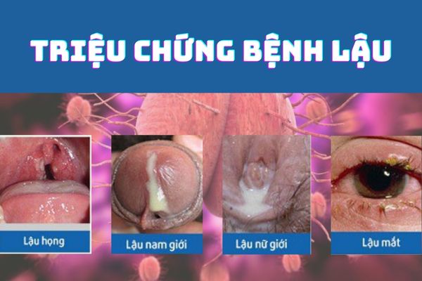 Bệnh sùi mào gà có thể lây nhiễm khi quan hệ bằng miệng