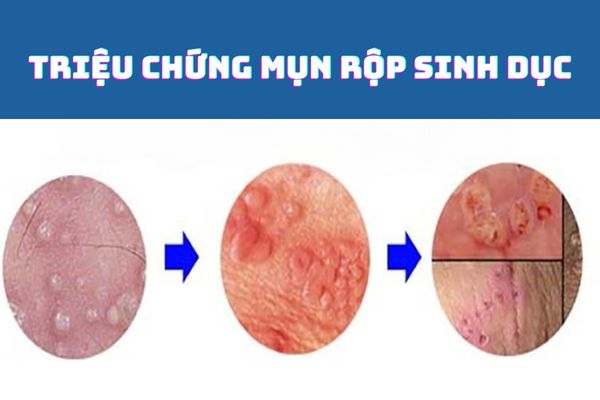 Triệu chứng bệnh mụn rộp sinh dục qua từng giai đoạn