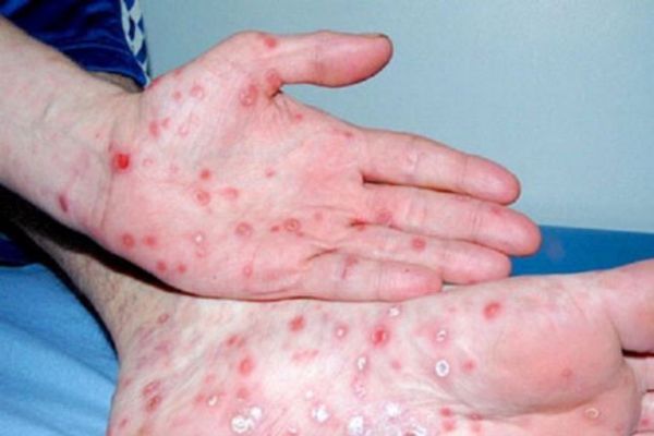 Bệnh giang mai dễ dàng phát sinh khi quan hệ gái Bar