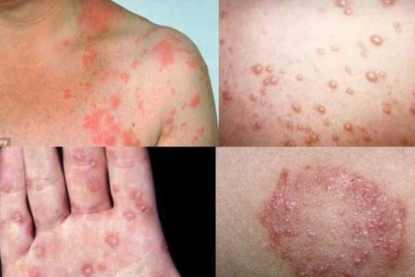 Lậu là bệnh xã hội phổ biến lây nhiễm qua quan hệ không an toàn