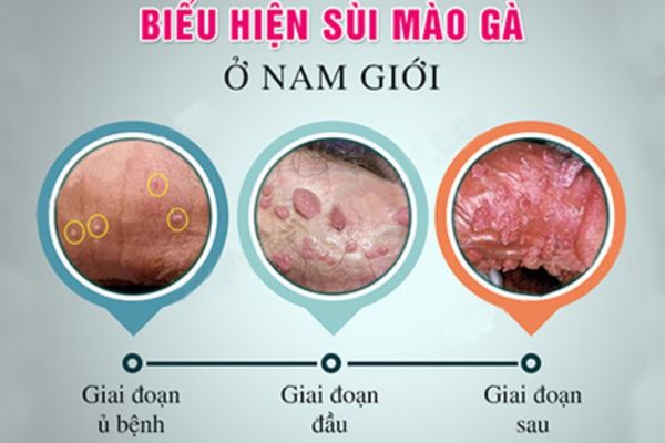 Sùi mào gà là bệnh lý dễ dàng phát sinh nếu quan hệ gái mại dâm