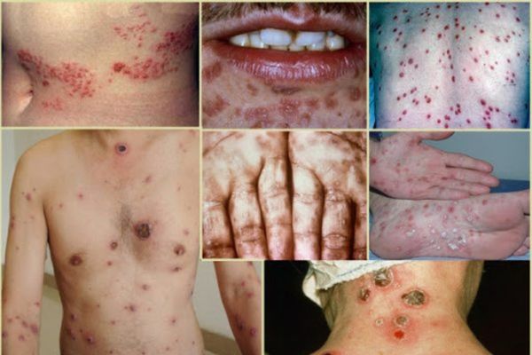 Dấu hiệu nhận biết bệnh giang mai