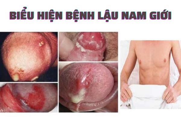 Triệu chứng bệnh lậu thường gặp ở nam giới