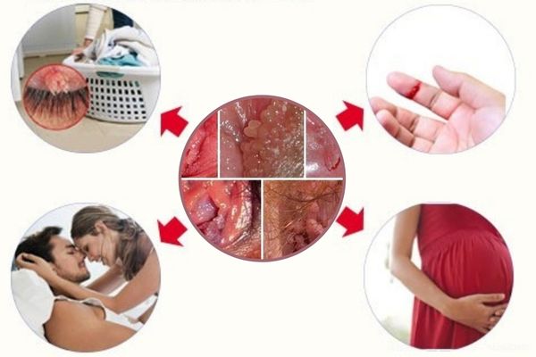 Các con đường lây nhiễm sùi mào gà âm đạo ở nữ giới