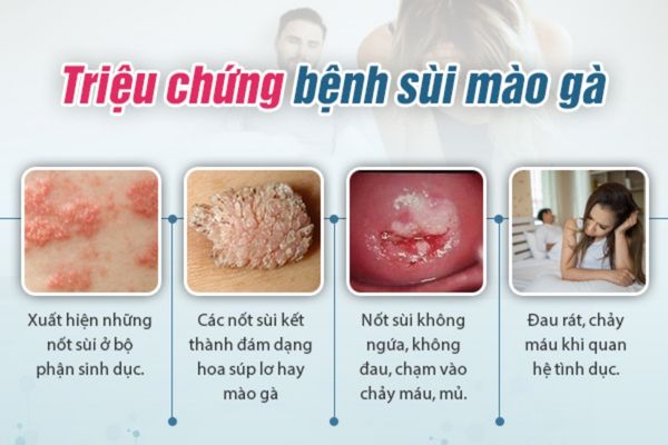 Dấu hiệu nhận biết sùi mào gà ở nữ