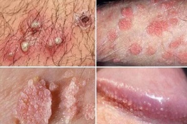 Sui-mao-ga-vung-kin-nam-2