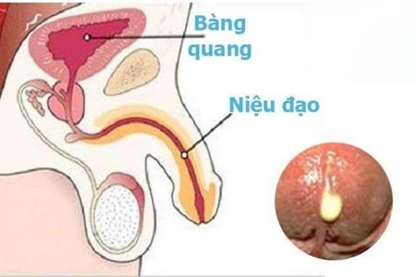 Tiểu có mủ là tình trạng bất thường gặp nhiều ở nam giới