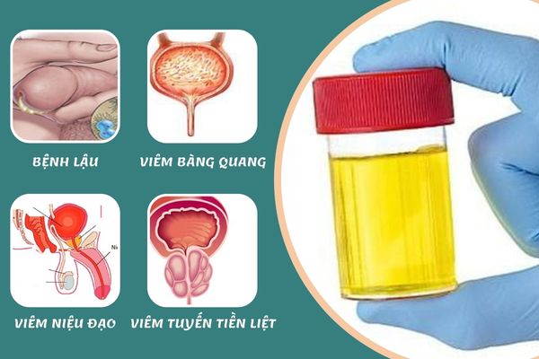 Tiểu có mủ là dấu hiệu cảnh báo của nhiều bệnh lý khác nhau