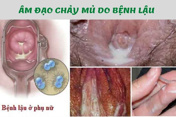 Âm đạo chảy mủ là dấu hiệu nhận biết bệnh lậu