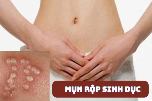 Mụn rộp sinh dục gây ra triệu chứng nổi mụn âm đạo