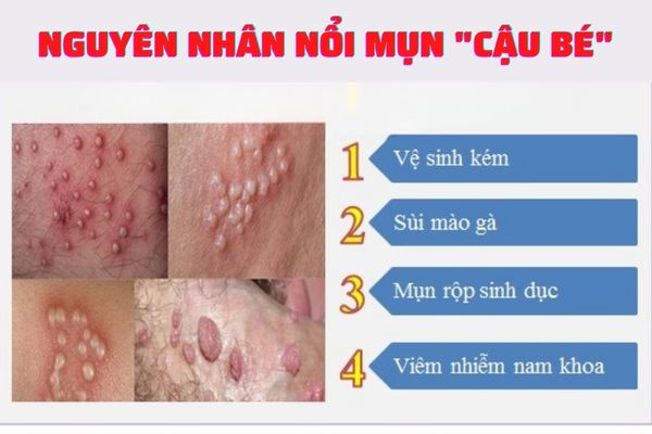 Nổi mụn cậu bé do nhiều nguyên nhân khác nhau gây ra
