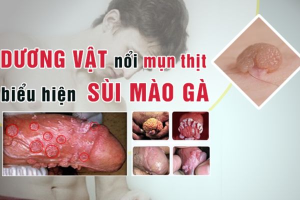 Nổi mụn ở dương vật là biểu hiện bệnh sùi mào gà
