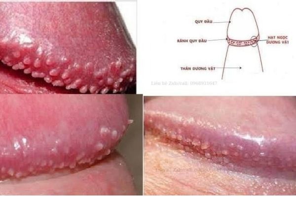 Chuỗi hạt ngọc dương vật gây ra tình trạng nổi mụn cậu nhỏ