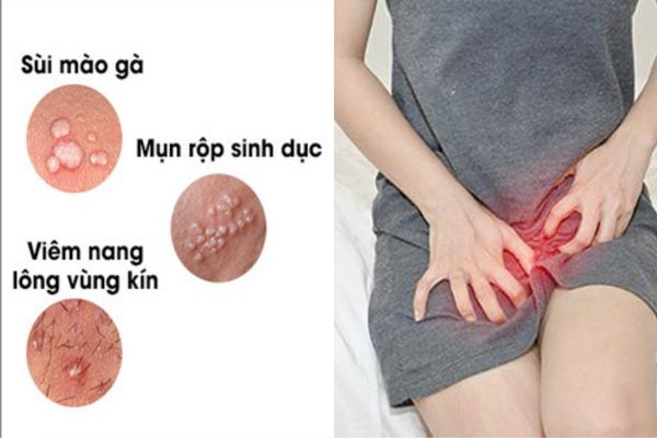 Nổi mụn cóc vùng kín ở là dấu hiệu cảnh báo nhiều bệnh lý nguy hiểm