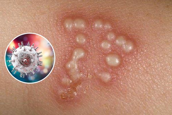 Nổi mụn ở bìu do bệnh mụn rộp sinh dục