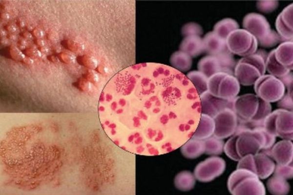 Bệnh lậu gây nổi mụn ở bìu