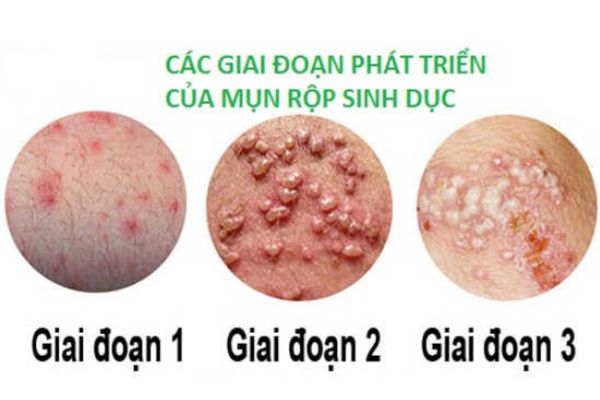 Mụn rộp sinh dục gây nổi mụn bất thường ở vùng kín nữ giới