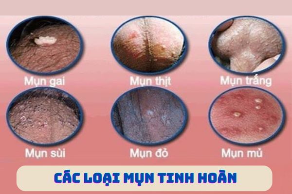 Các loại mụn thường gặp ở tinh hoàn nam giới