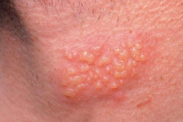 Mụn rộp sinh dục gây ra tình trạng nổi mụn ở tinh hoàn