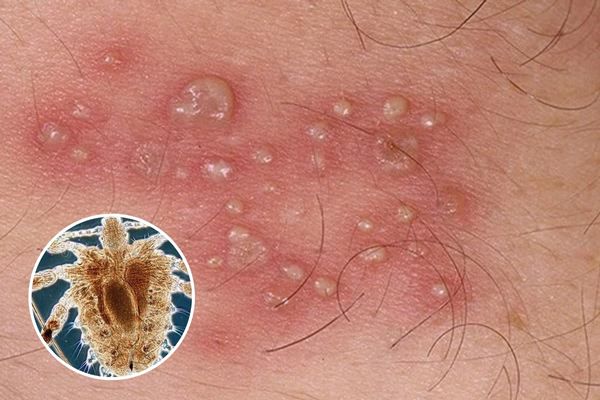 Nổi mụn tinh hoàn do rận mu gây ra