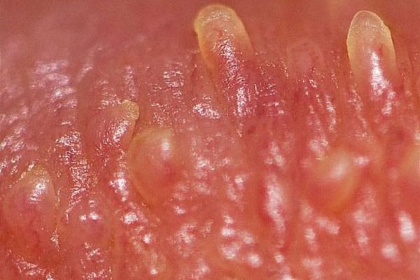 U nhú âm đạo lành tính ở nữ giới