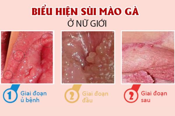 U nhú âm đạo là dấu hiệu nhận biết bệnh sùi mào gà