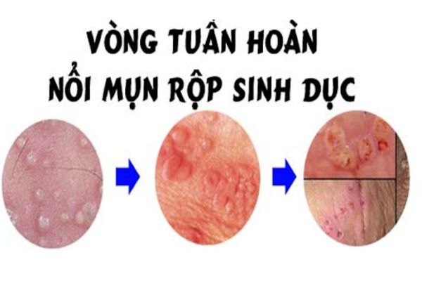 U nhú âm đạo do bệnh mụn rộp sinh dục gây ra