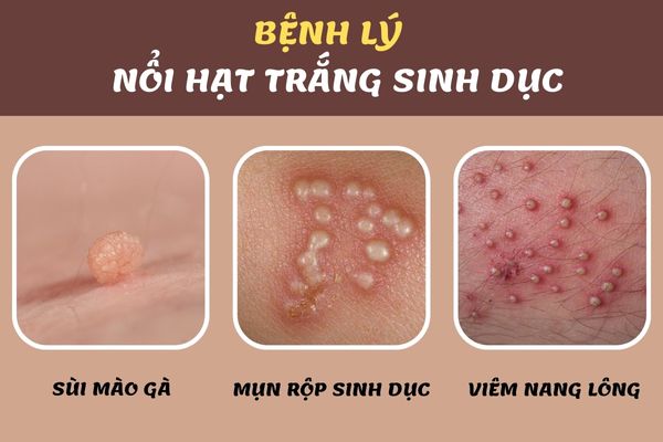 Nổi hạt trắng sinh dục cảnh báo nhiều bệnh lý nguy hiểm