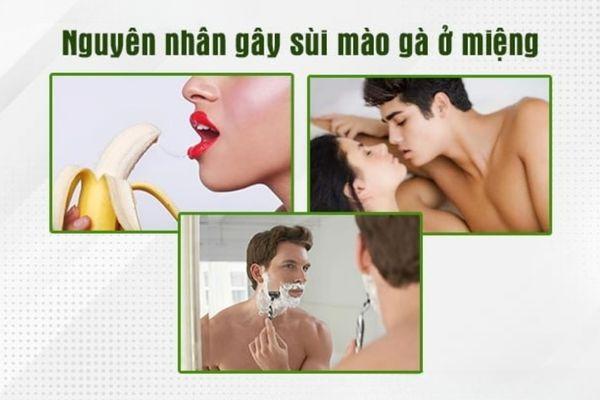 Sùi mào gà ở miệng lây qua nhiều đường khác nhau