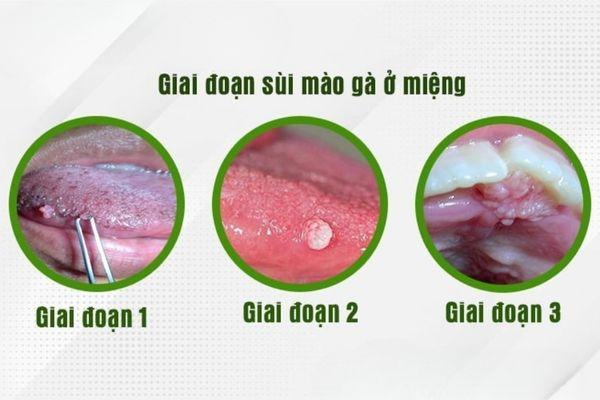 Các triệu chứng nhận biết sùi mào gà ở miệng
