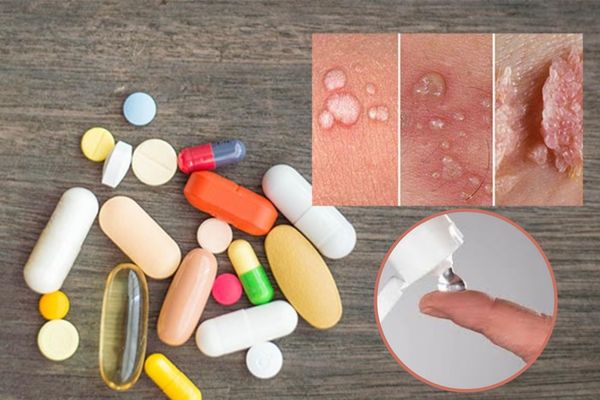 Các loại thuốc sùi mào gà được sử dụng phổ biến hiện nay