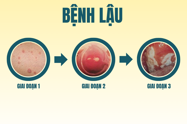 Thong-tin-benh-xa-hoi-o-nam-va-nu-can-luu-y-3