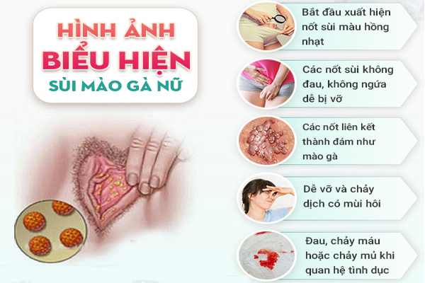 Nhận biết dấu hiệu sùi mào gà ở nữ giới