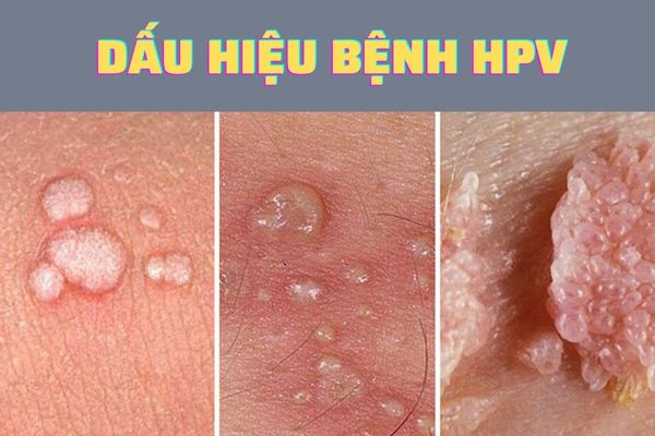 Benh-hpv-2