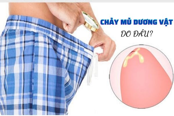 Nguyên nhân chảy mủ ở nam giới – Cách điều trị hiệu quả