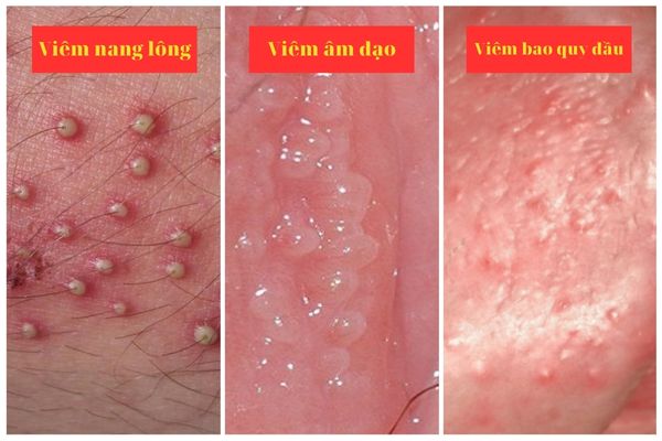 mun-vung-kin-la-bi-gi-va-khac-phuc-ra-sao-3